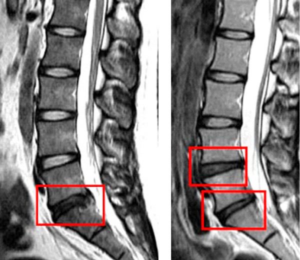 Symptômes du trouble discal juvénile