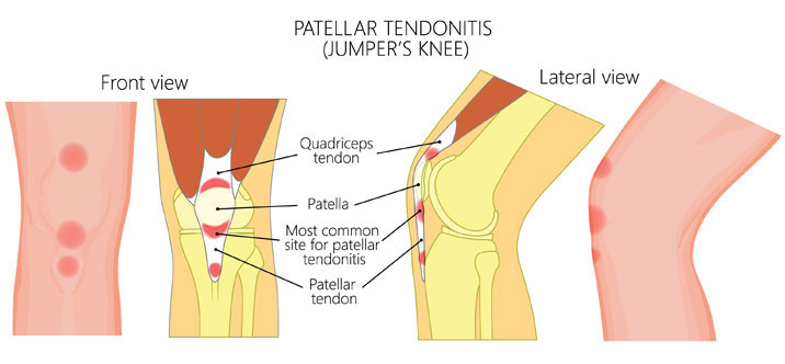 ¿Qué es el dolor del tendón rotuliano?