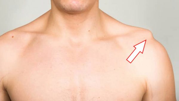 Symptome einer getrennten Schulter