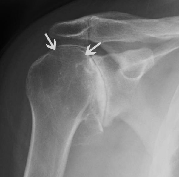 Arthritis in der Schulter