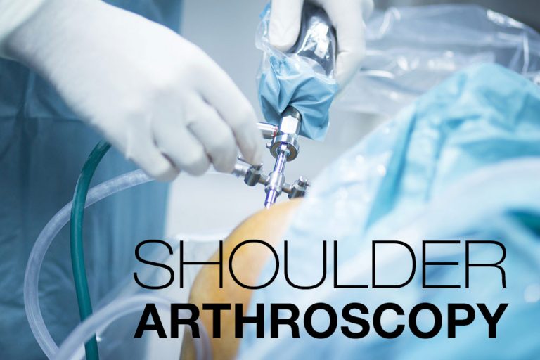 Shoulder Arthroscopy Symptoms, Causes, Treatment By Shoulder Braces