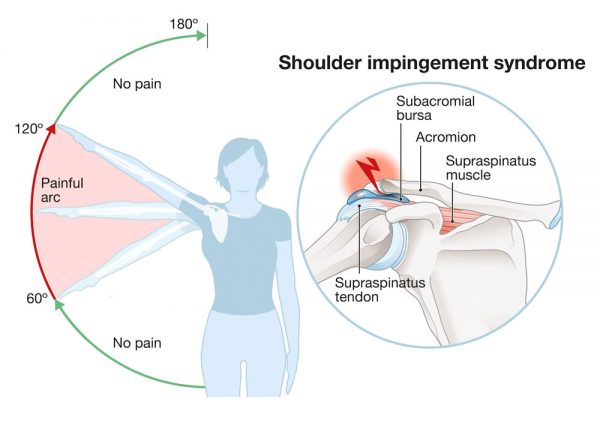 Schulter-Impingement-Syndrom