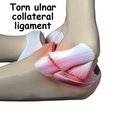 Ulnar Collateral Ligament