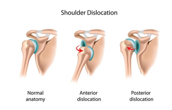 ¿Qué causa la inestabilidad del hombro?