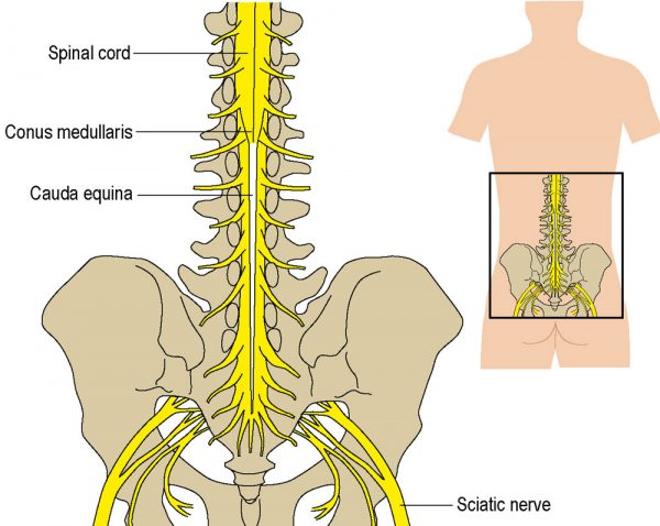 What causes cauda equina syndrome