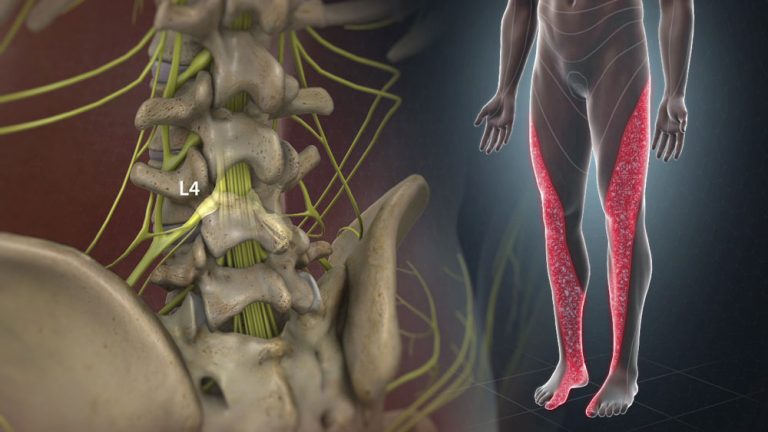 Lumbar Radiculopathy: Symptoms, Causes, Treatment By Lumbar Braces