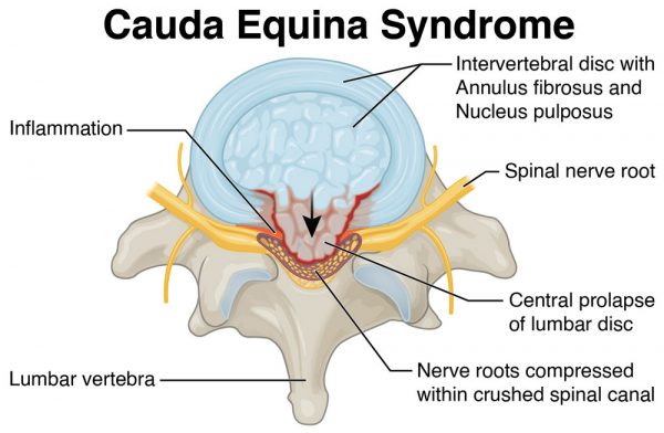 Was ist das Cauda-Equina-Syndrom?
