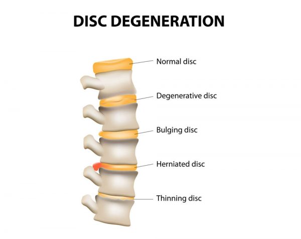 Was ist Juvenile Disc Disorder