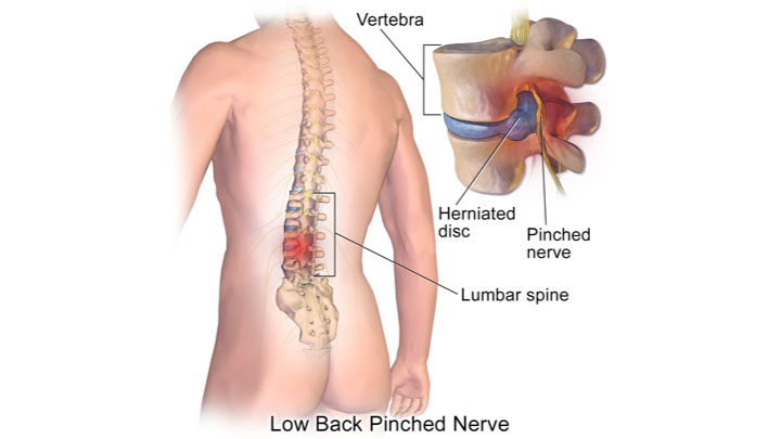 Was sind Rückenschmerzen