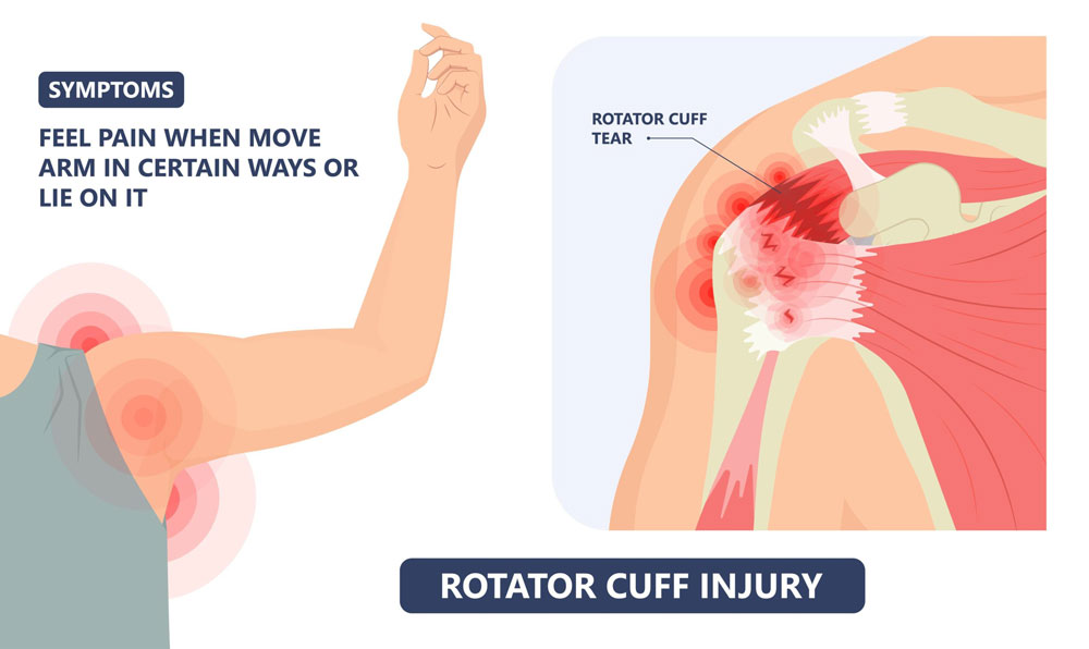 What is Rotator Cuff Tear
