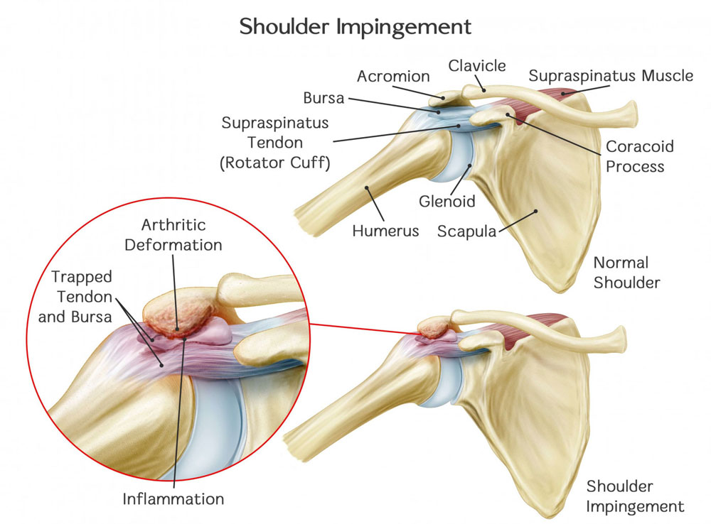 What is Shoulder Impingement