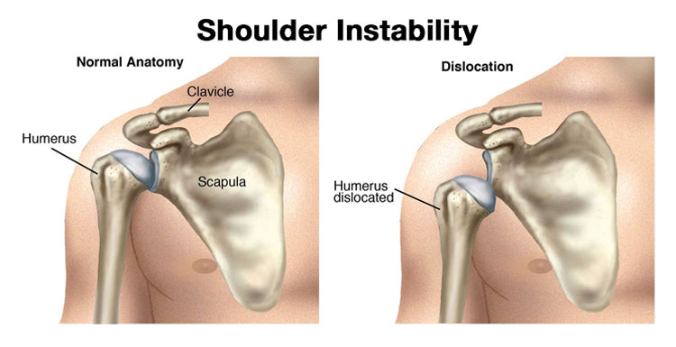 ¿Qué es la inestabilidad del hombro?