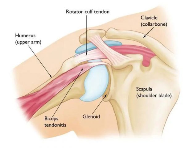 ¿Qué es la tendinitis del hombro?