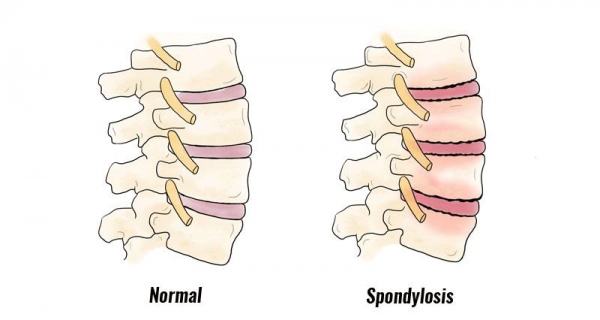 Was ist Spondylose