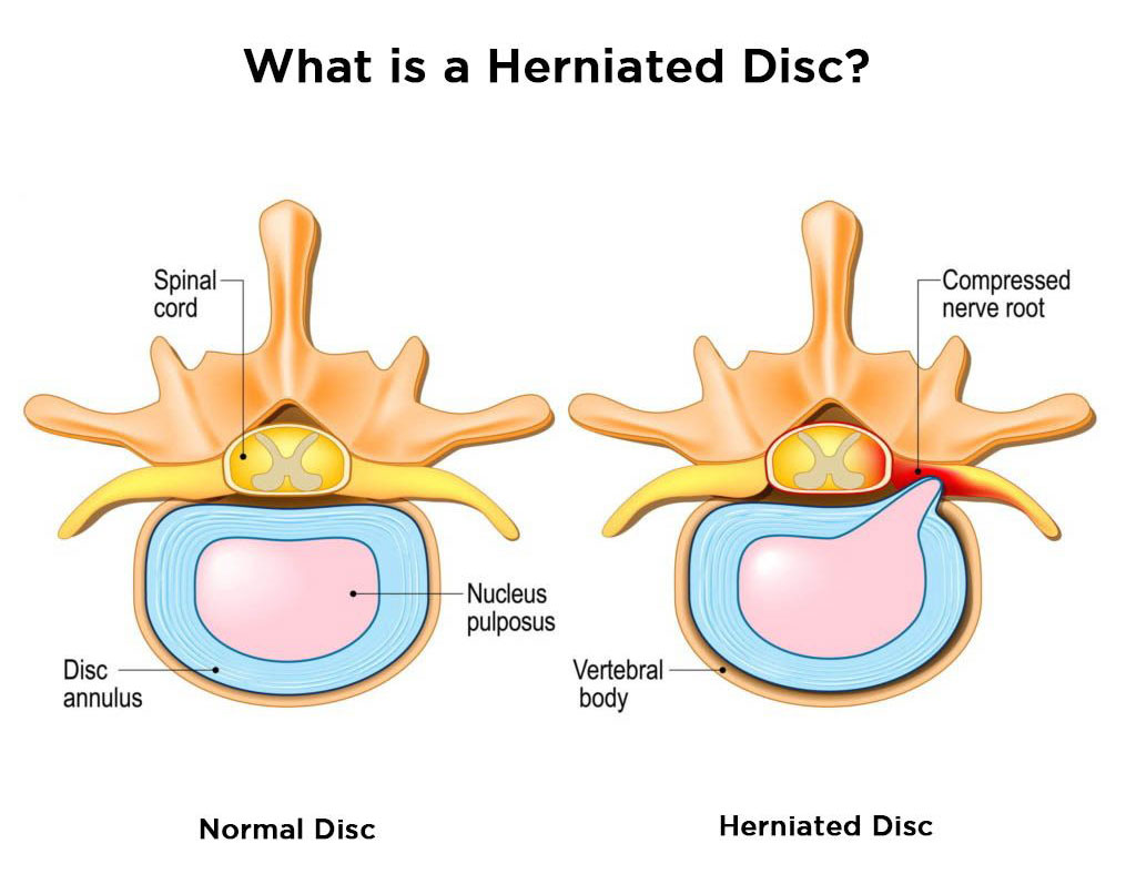 ¿Qué es una hernia de disco?