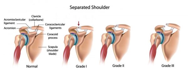¿Qué es un hombro separado?