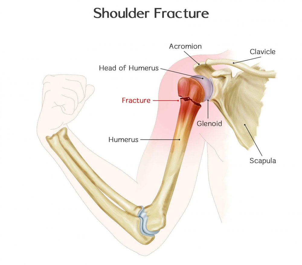 ¿Qué es una fractura de hombro?