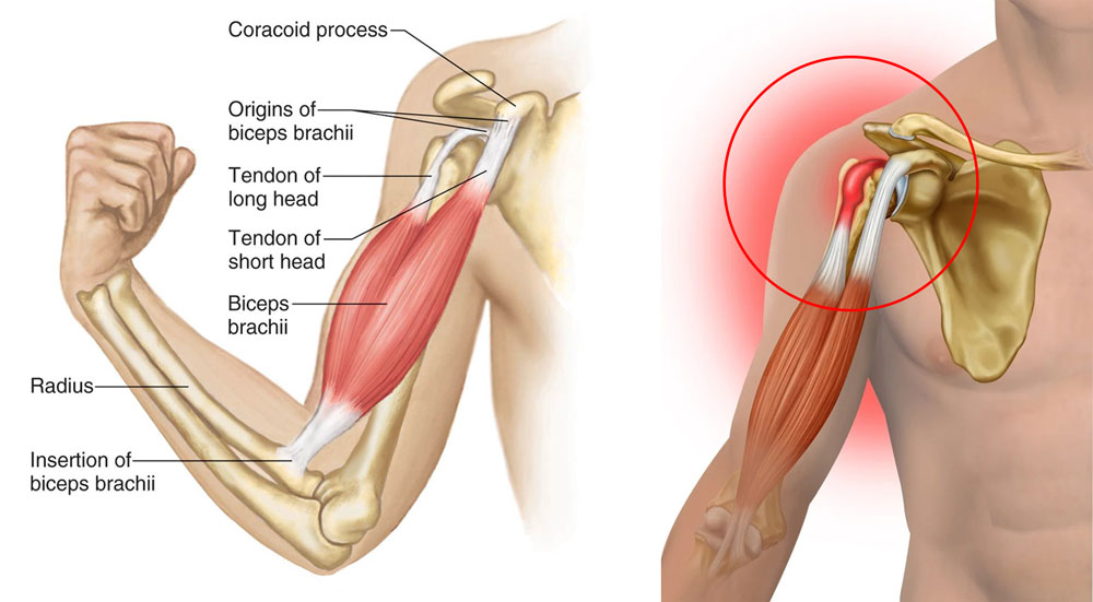 ¿Qué es la tendinitis del bíceps?