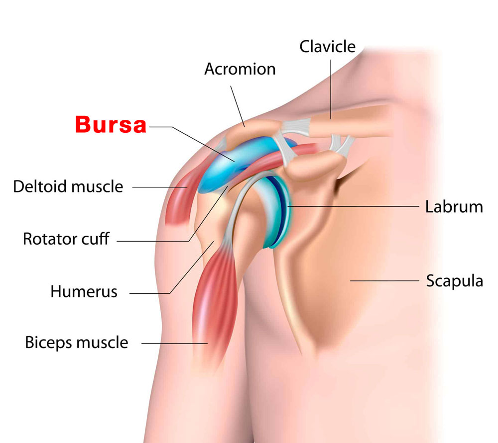 What is bursitis of the shoulder