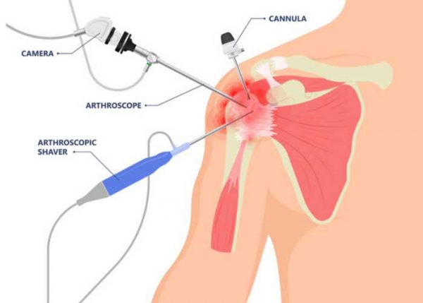 What is shoulder arthroscopy