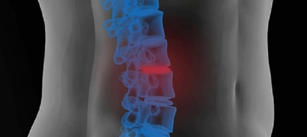 What is the best treatment for Spondylosis?