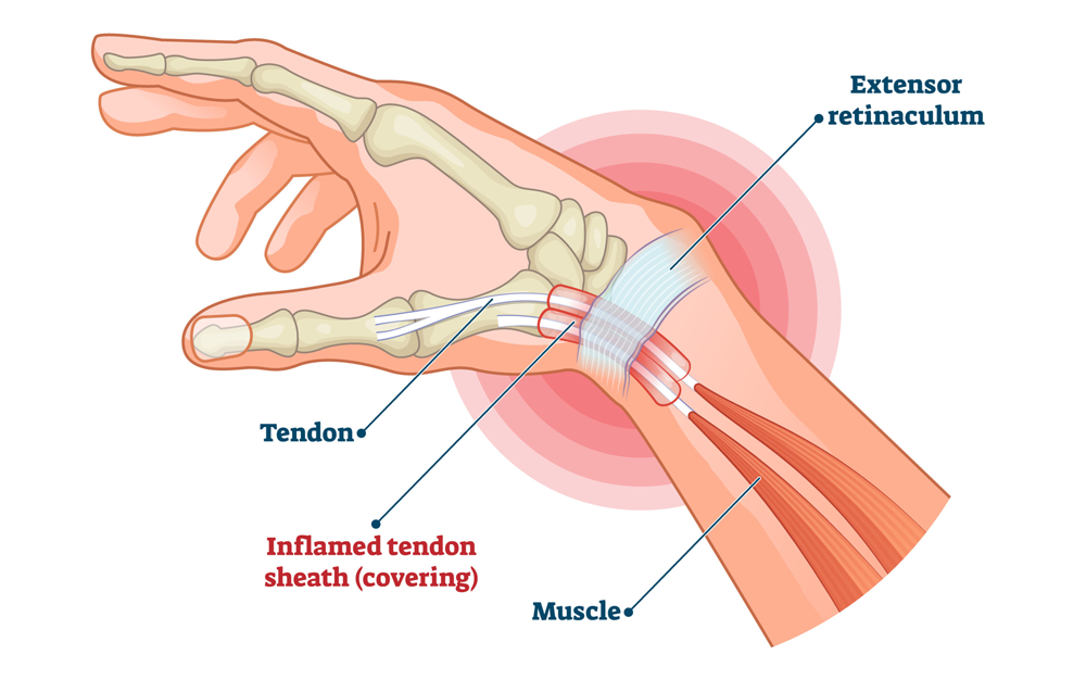 Tendinitis de muñeca