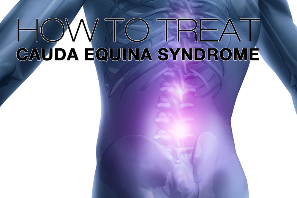 cauda equina syndrome