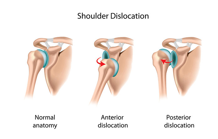 what is Shoulder Dislocation