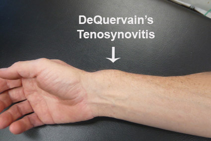 Sintomas de tenossinovite de De Quervain