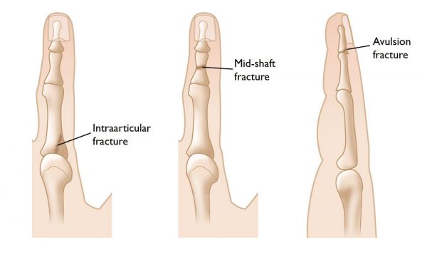 Finger-Fractures