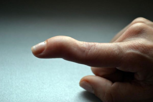 MALLET FINGER SYMPTOMS