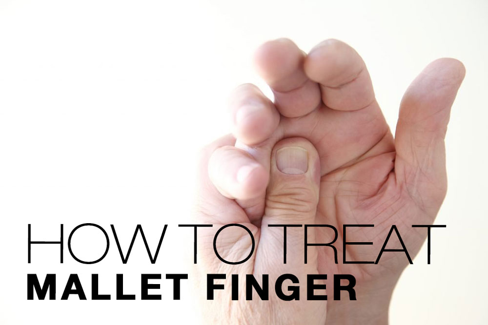 Mallet Finger: Causes, Symptoms, and Treatment