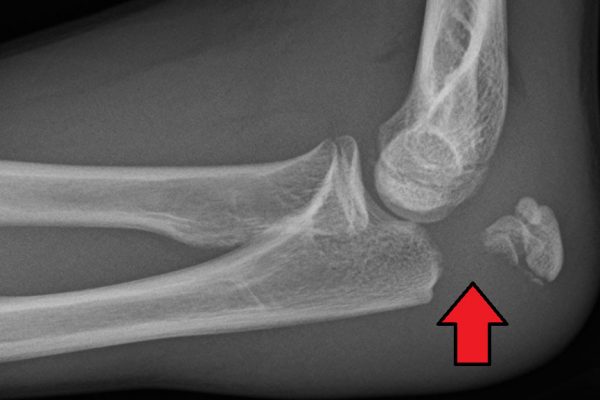 Síntomas de la fractura por estrés del olécranon