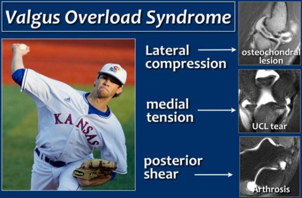 VALGUS EXTENSION OVERLOAD SYNDROME