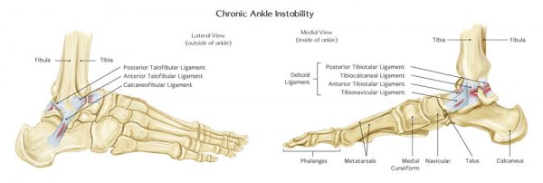WHAT IS CHRONIC ANKLE INSTABILITY?