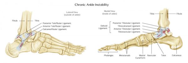 ¿QUÉ ES LA INESTABILIDAD CRÓNICA DEL TOBILLO?