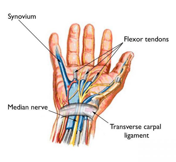 WHAT IS FLEXOR TENDONITIS?