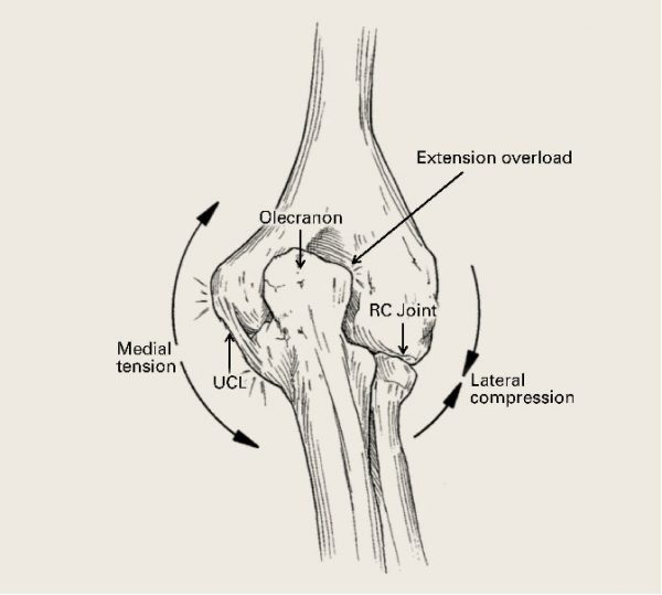 WHAT IS VALGUS EXTENSION OVERLOAD?