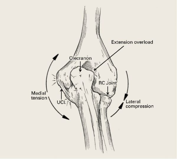 QU'EST-CE QUE LA SURCHARGE D'EXTENSION VALGUS ?