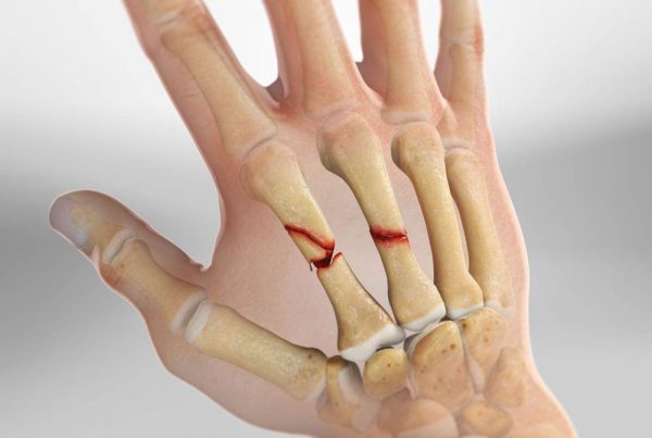 What Are Hand Fractures?