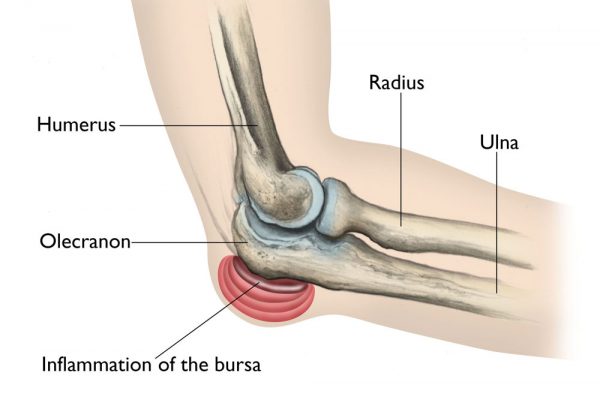 Que sont les fractures de stress de l'olécrâne