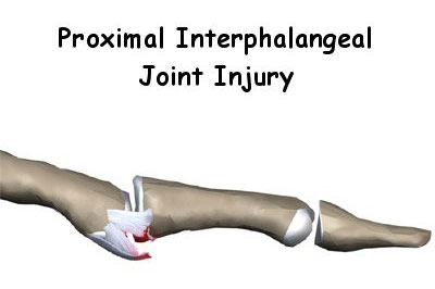Dislocations of the PIP joint