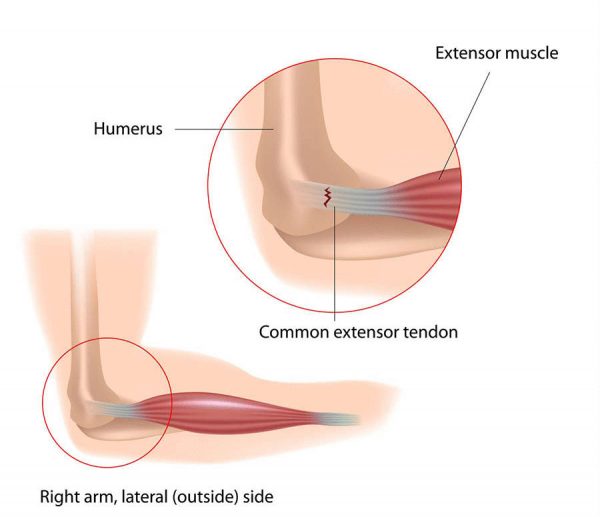 What Causes Tennis Elbow?