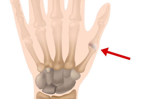 What Causes Thumb Sprain, and What Does It Feel Like