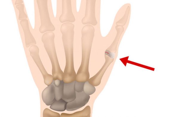 Qué causa el esguince de pulgar y cómo se siente