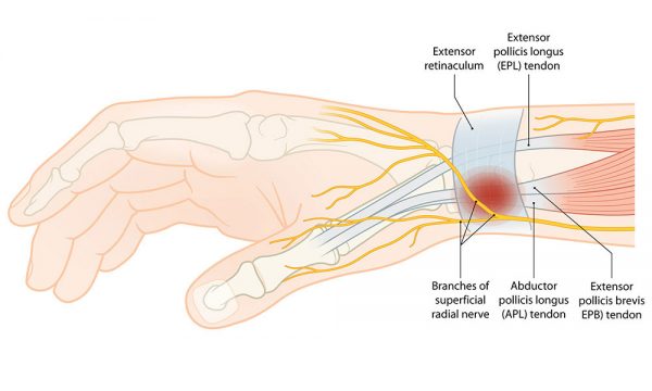 What Is De Quervain's Syndrome?