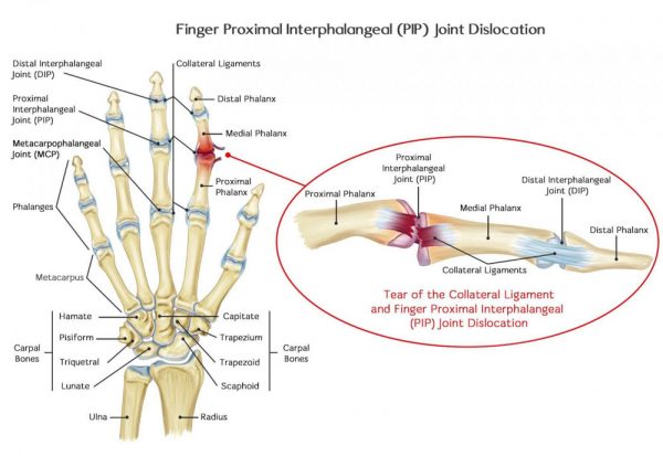 ¿Qué es la dislocación de la articulación PIP?