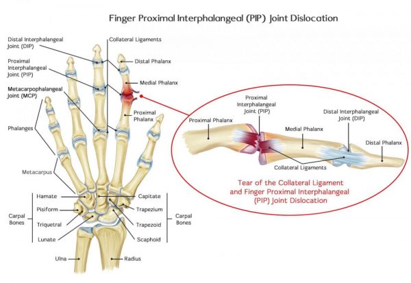 Qu'est-ce que la luxation de l'articulation PIP ?