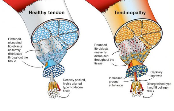 Was ist Tendinopathie?