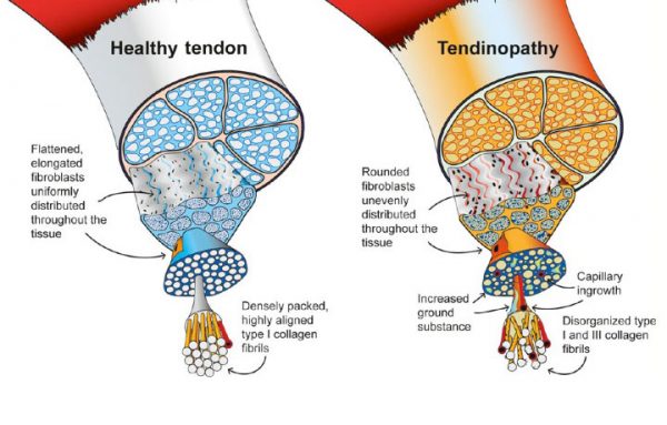 Qu'est-ce que la tendinopathie ?